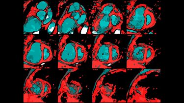 Stylised image of short axis stack cardiac MRI