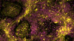 Fluorescently labelled mutant stem cells differentiated toward sympathetic neurons. Image recorded by Dr. Ingrid Saldana