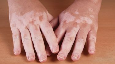 Person with vitiligo