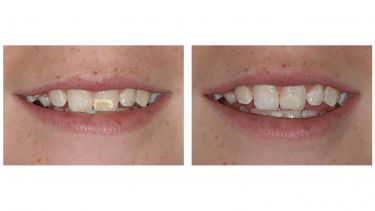 A patient's enamel before treatment and after treatment. There is a noticeable difference. 