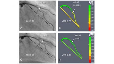 Diagrams depicting Virtual Coronary Intervention.