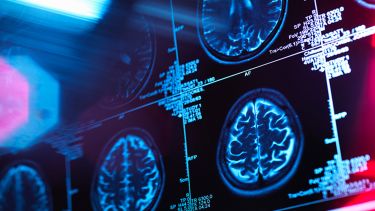 A photograph of different brain scans. 