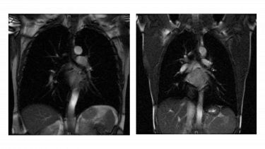 Two images above show a proton image of a healthy volunteers lungs (on the left) to a COPD patients lungs (on the right). There isn’t an obvious difference between the two.