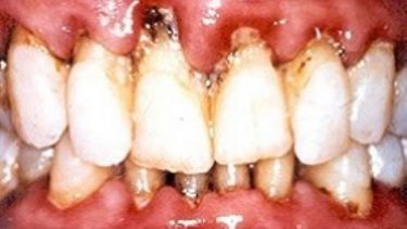 Example of periodontitis