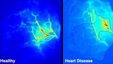 neurovascular function, heart disease