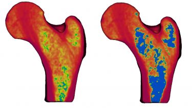 Multiscale model of an adult femur showing the change of bone mineral density at the ages of 60 and 70