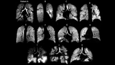 Ventilation images of children with primary ciliary dyskinesia
