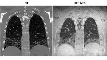 CT and UTE MRI in CTD-ILD