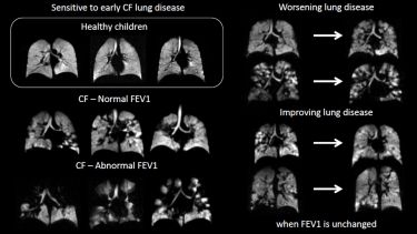 Hyperpolarised gas MRI is sensitive to early CF lung disease
