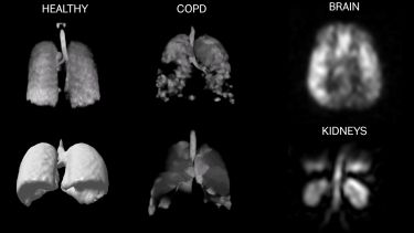 Hyperpolarised 129Xe images in healthy and COPD lungs, and the brain and kidneys