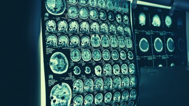 Virtual biopsy of a brain