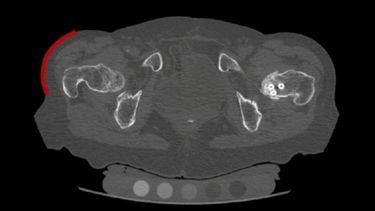 An MRI of a patient's hip