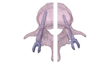 3D diagram of pedicle screws in a vertebra