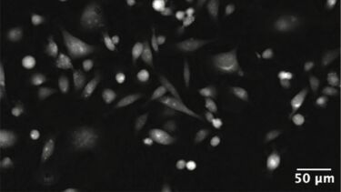 Microscopy image of triple negative breast cancer cells