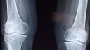 X-ray of knee bones