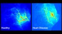 image shows health images of cells versus those with heart disease