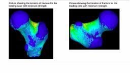 CT2S Service – Computer Tomography to Strength Report showing results of Finite Element Analysis of a patient's Femur