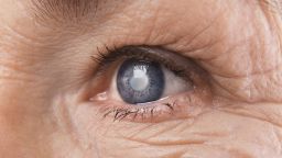 Close up of older woman's eye which has a cataract