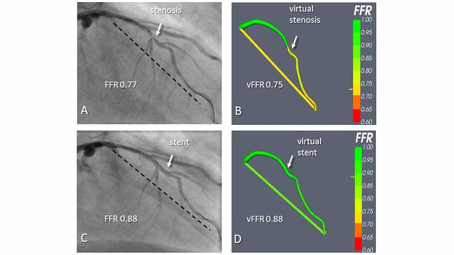 Thumbnail for Virtual Coronary Intervention - A Treatment Planning Tool Based Upon the Angiogr…