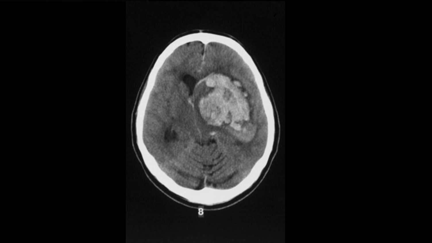 Thumbnail for A new gold standard treatment for the emergency correction of warfarin-induced c…