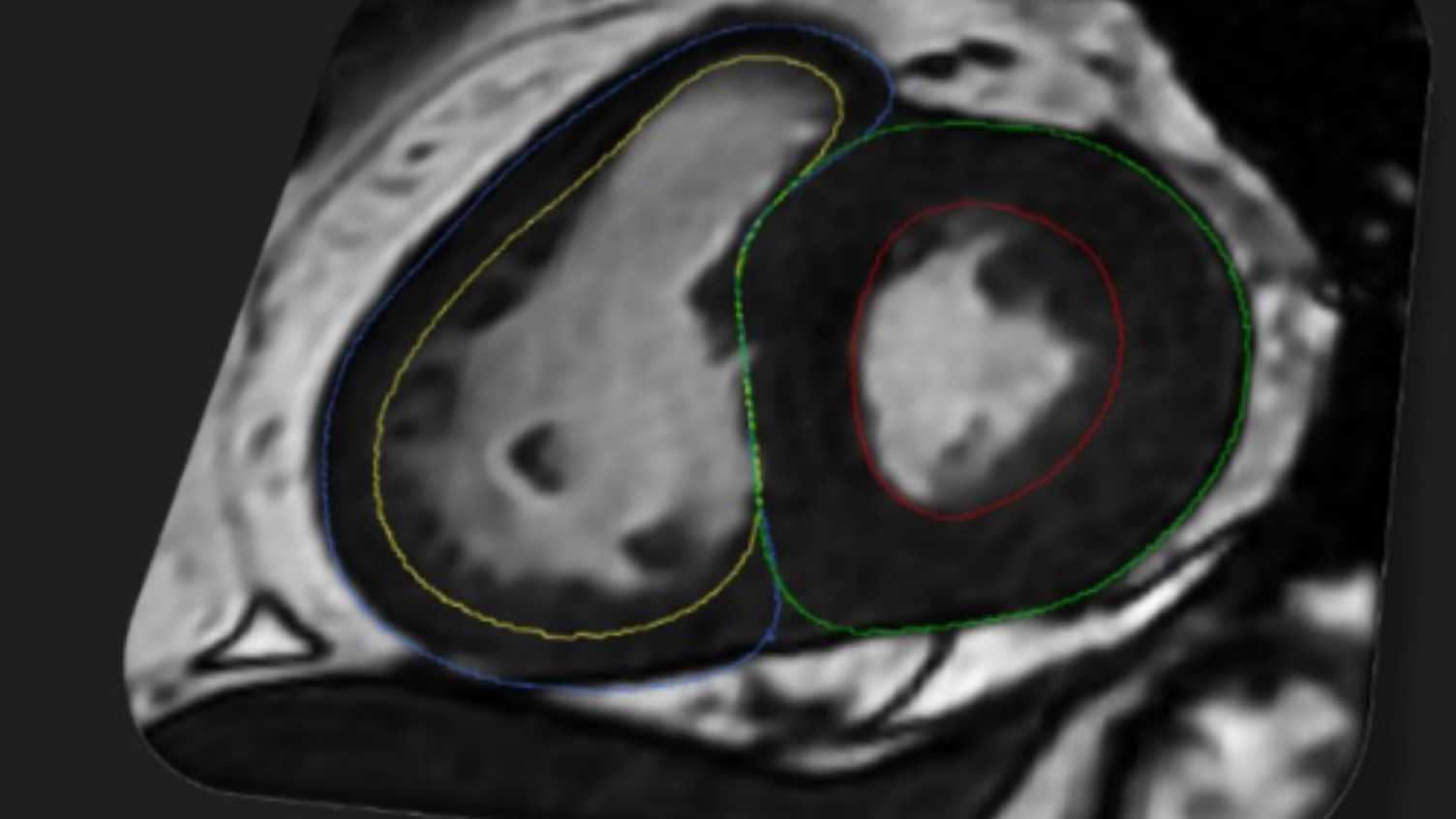 Thumbnail for Researchers develop award-winning tool using AI to measure heart’s function | …