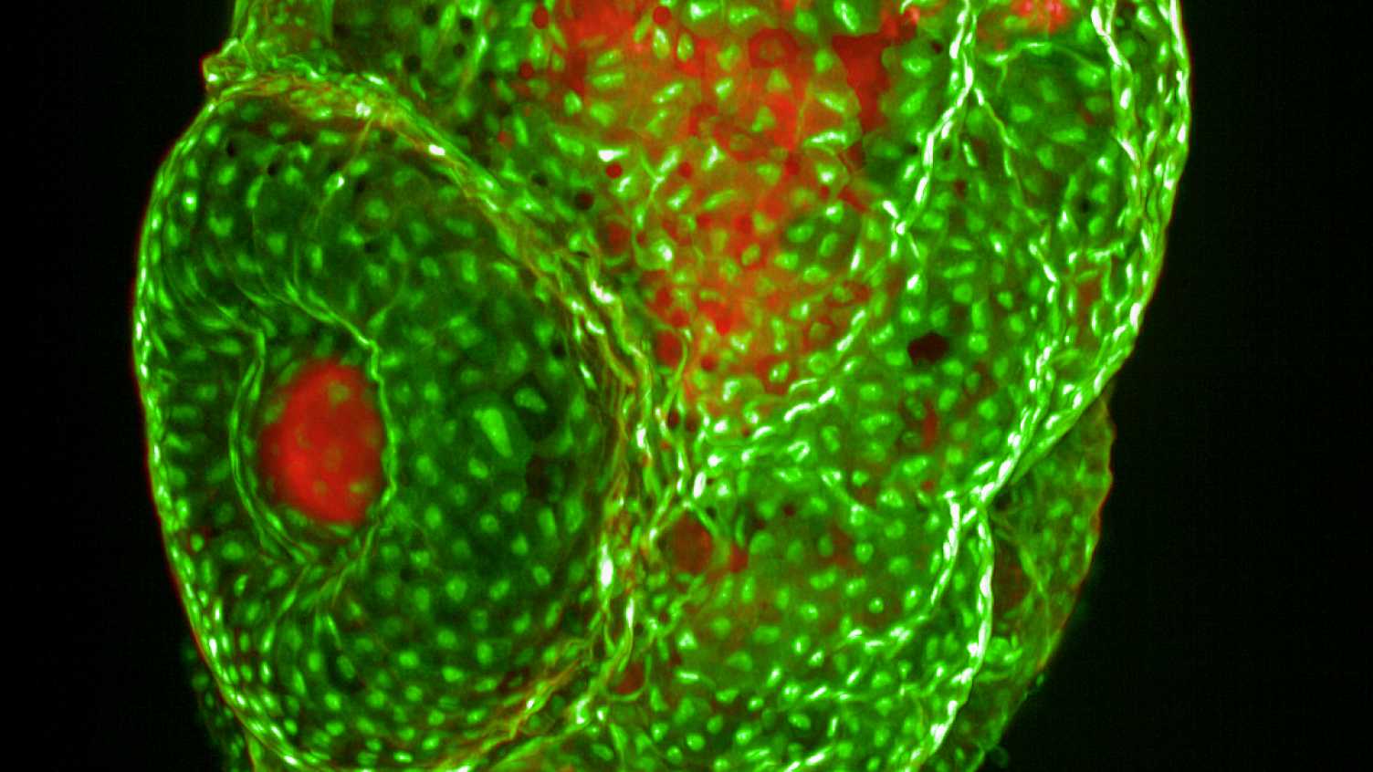 Thumbnail for Multiple sclerosis | SITraN 