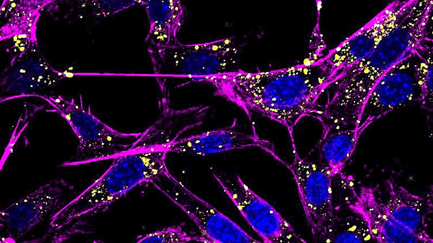 Thumbnail for Unlocking the secrets of cancer spread: A step toward new therapies | Bioscience…